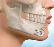 cirugias dentales odontologicas