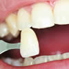 carillas dentales