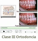 Clase III Ortodoncia