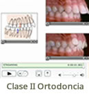 Clase II Ortodoncia